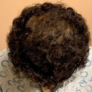 Hair Transplant Case 07