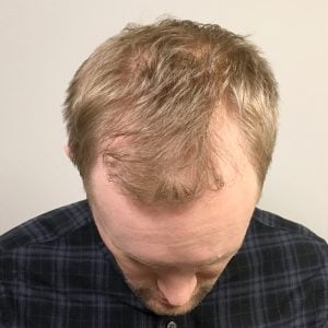 unshaven fue before and after