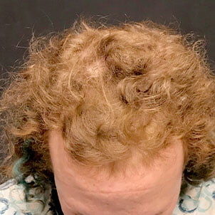 Hair Transplant Case 05