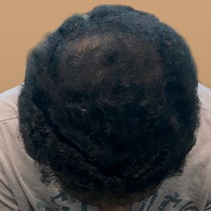 Hair Transplant Case 07