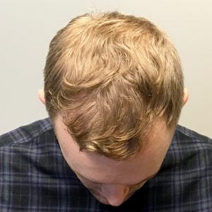 No Shave FUE hair transplant before and after