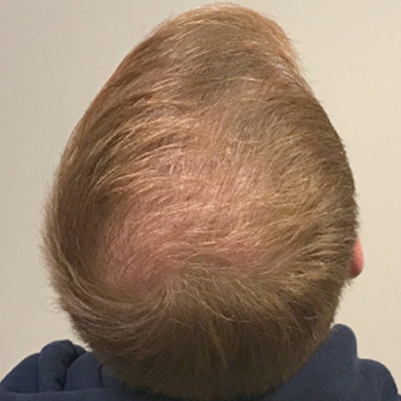 Hair Transplant Case 03