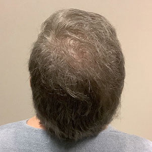 Hair Transplant Case 04