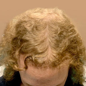 Hair Transplant Case 05