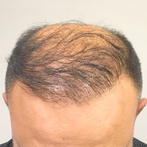 Hair Transplant Case 06