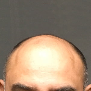 Hair Transplant Case 06