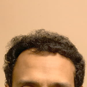 Hair Transplant Case 07