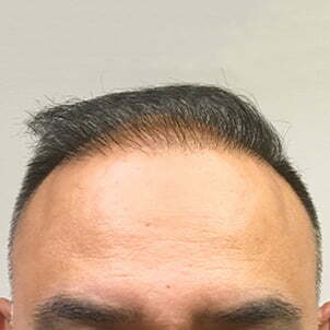 Hair Transplant Case 06