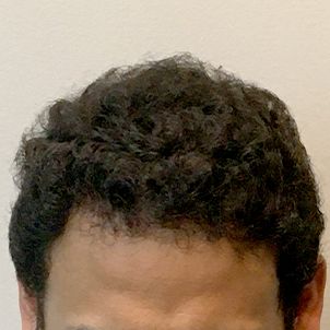 Hair Transplant Case 07