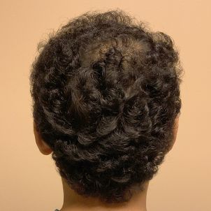 Hair Transplant Case 07