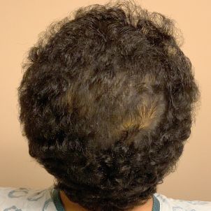 Hair Transplant Case 07