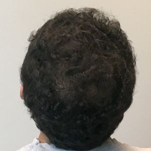 Hair Transplant Case 07