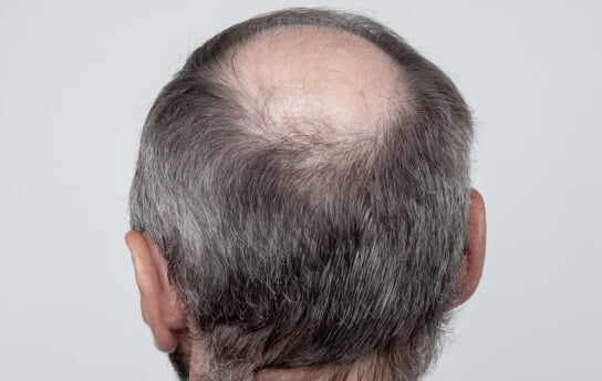 The Norwood Scale: What Are The 7 Stages Of Male Pattern Baldness?