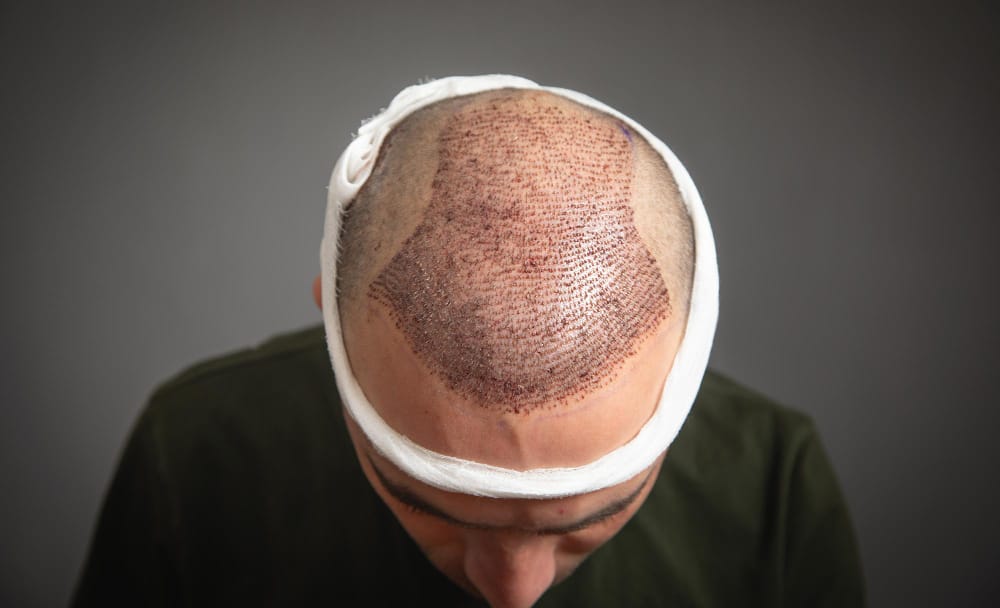 Do You Have to Take Medicine After Hair Transplant?