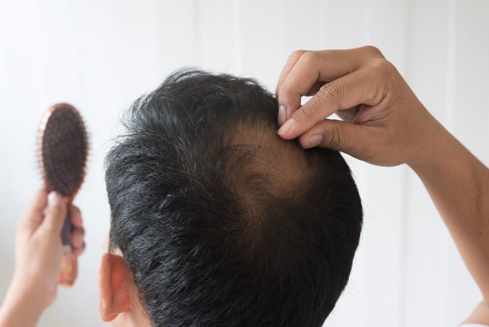 Can You Have a Hair Transplant Without Shaving? Unshaven FUE Hair Transplant Guide