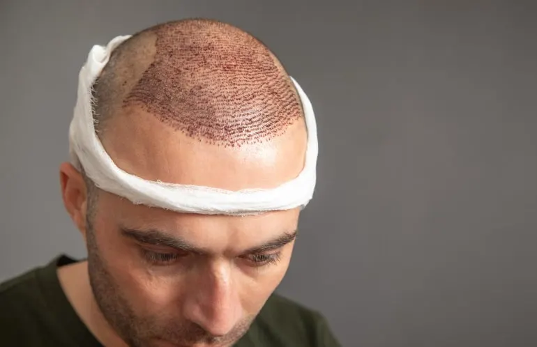 When Can You Exercise After An FUE Hair Transplant