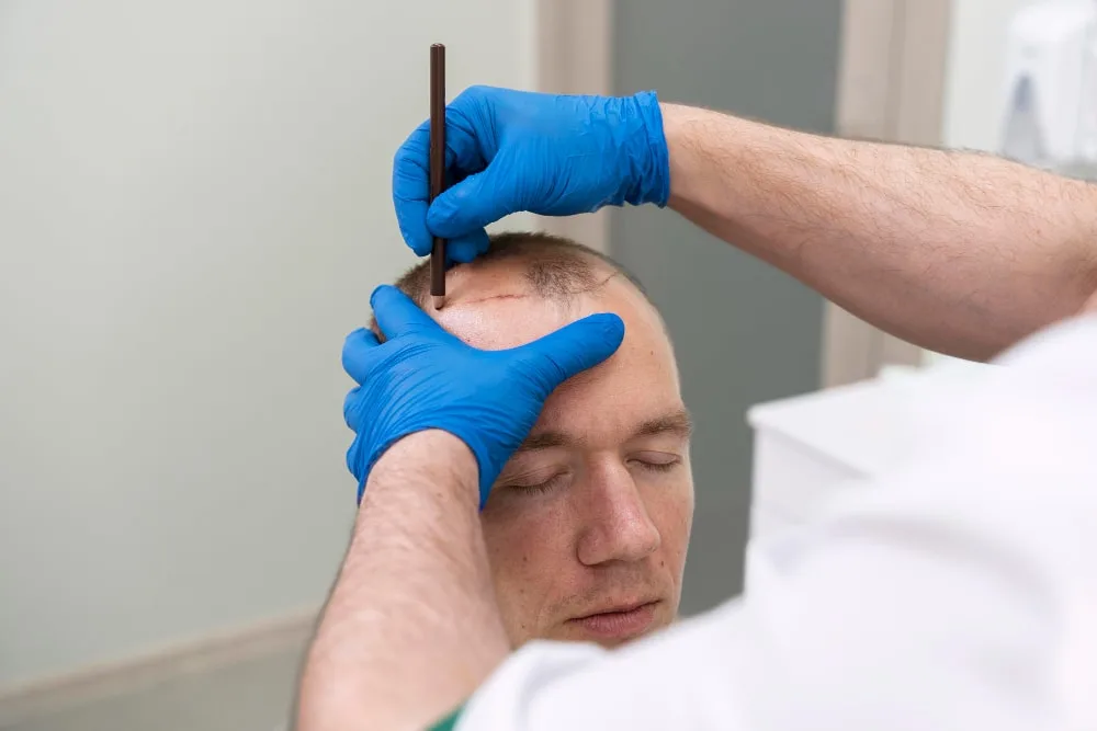 Week 3 After Hair Transplant: What to Expect and How to Take Care of Your Scalp