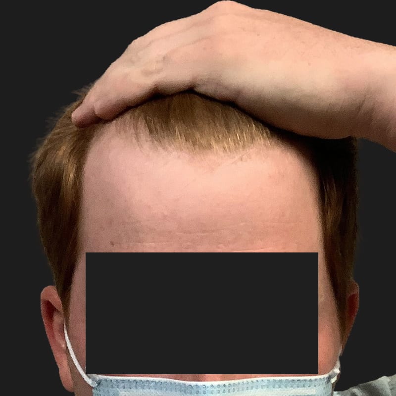 Hair Transplant Case 09