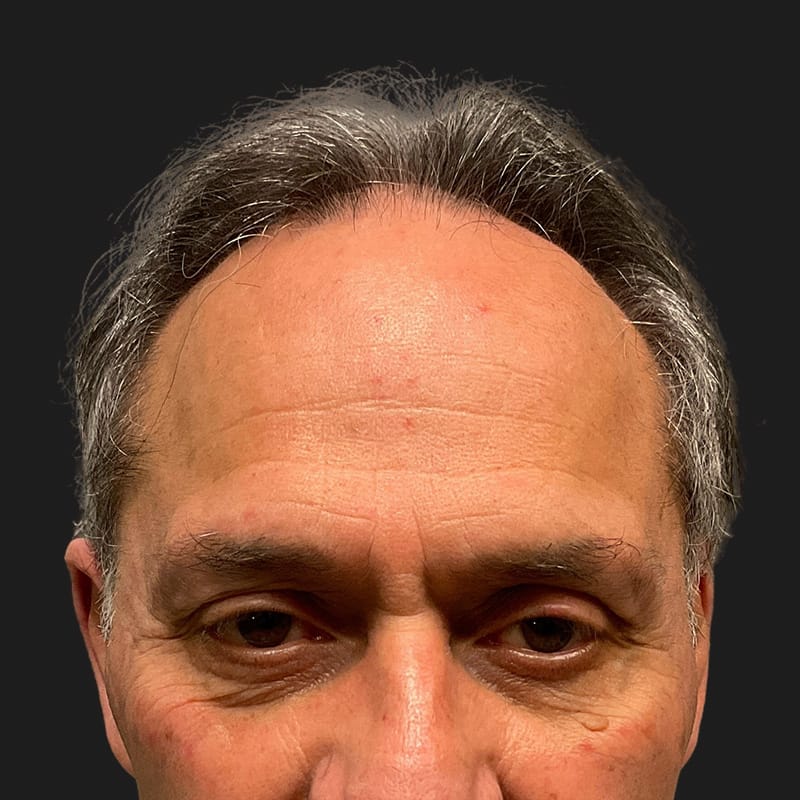 Hair Transplant Case 08