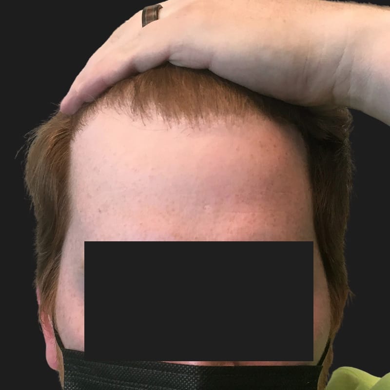 Hair Transplant Case 09