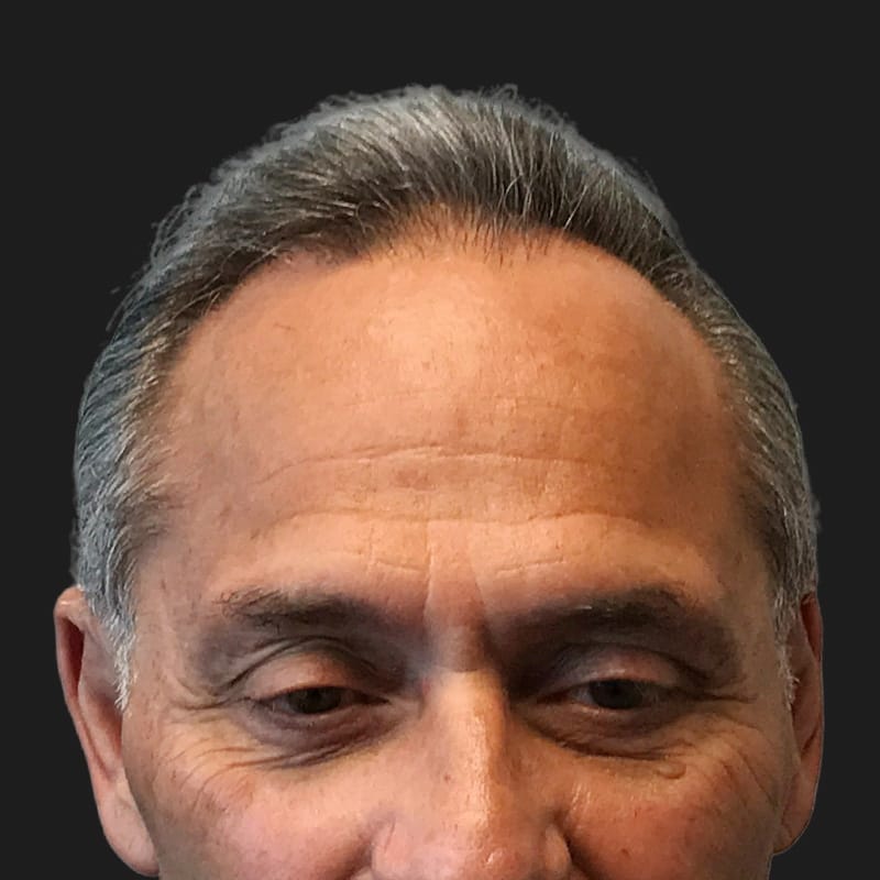 Hair Transplant Case 08