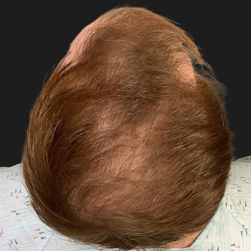 Hair Transplant Case 09