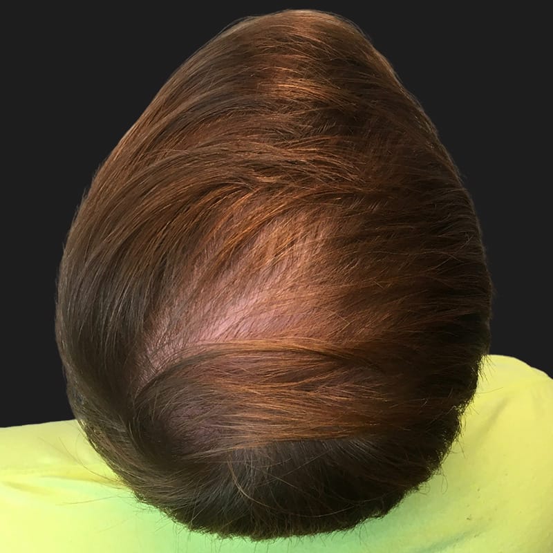 Hair Transplant Case 09