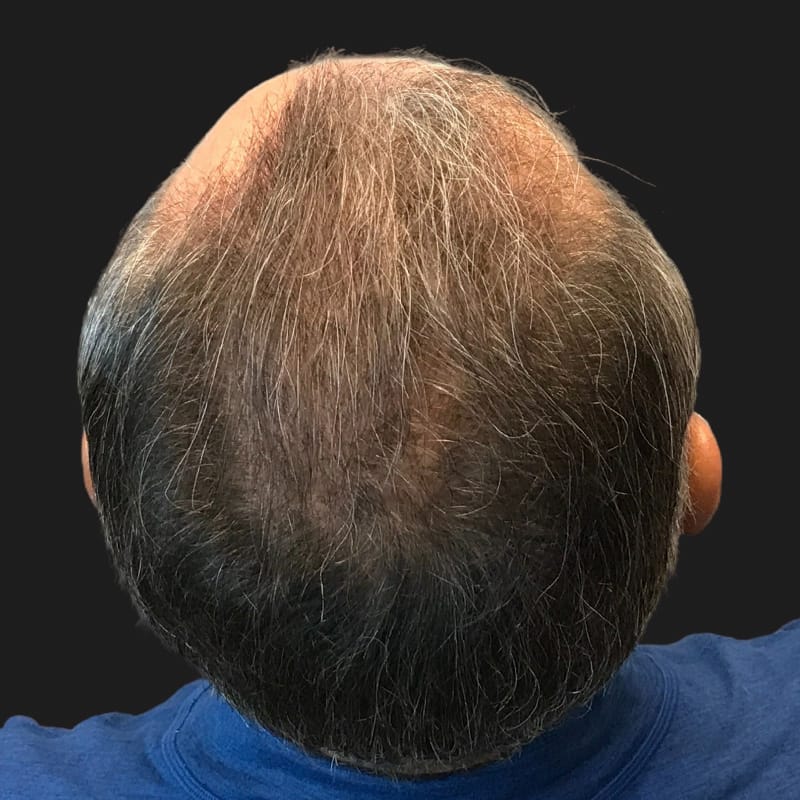 Hair Transplant Case 08