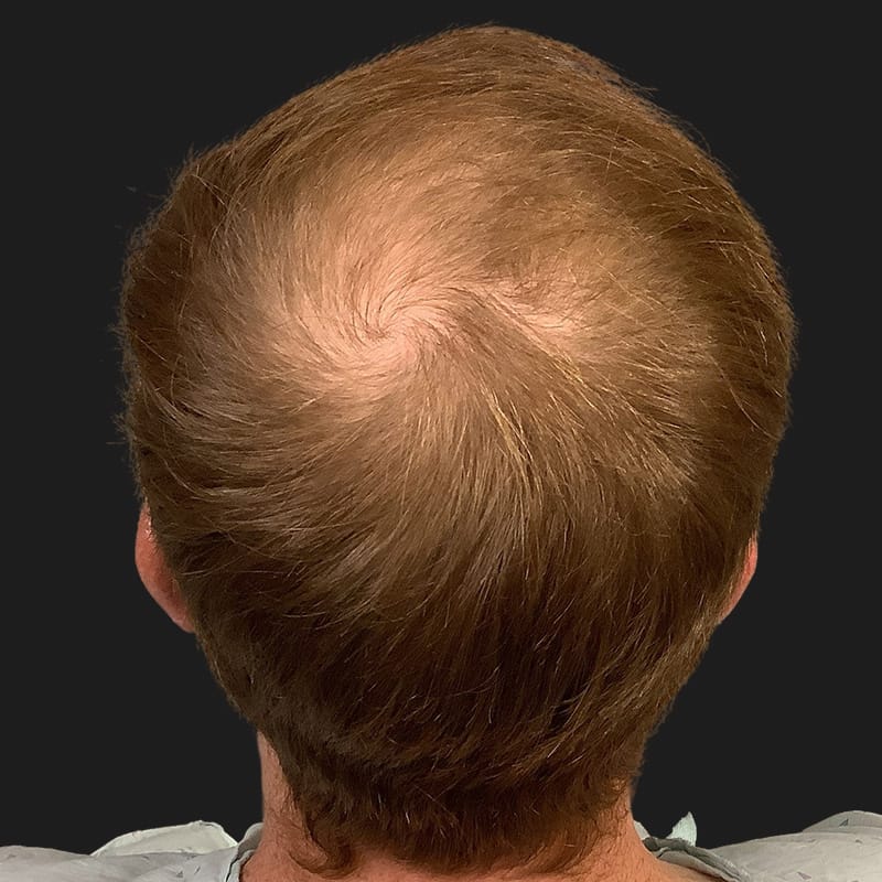 Hair Transplant Case 09