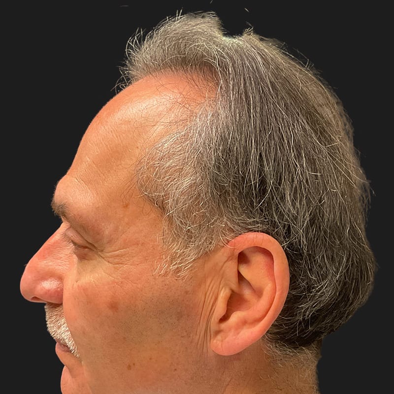 Hair Transplant Case 08