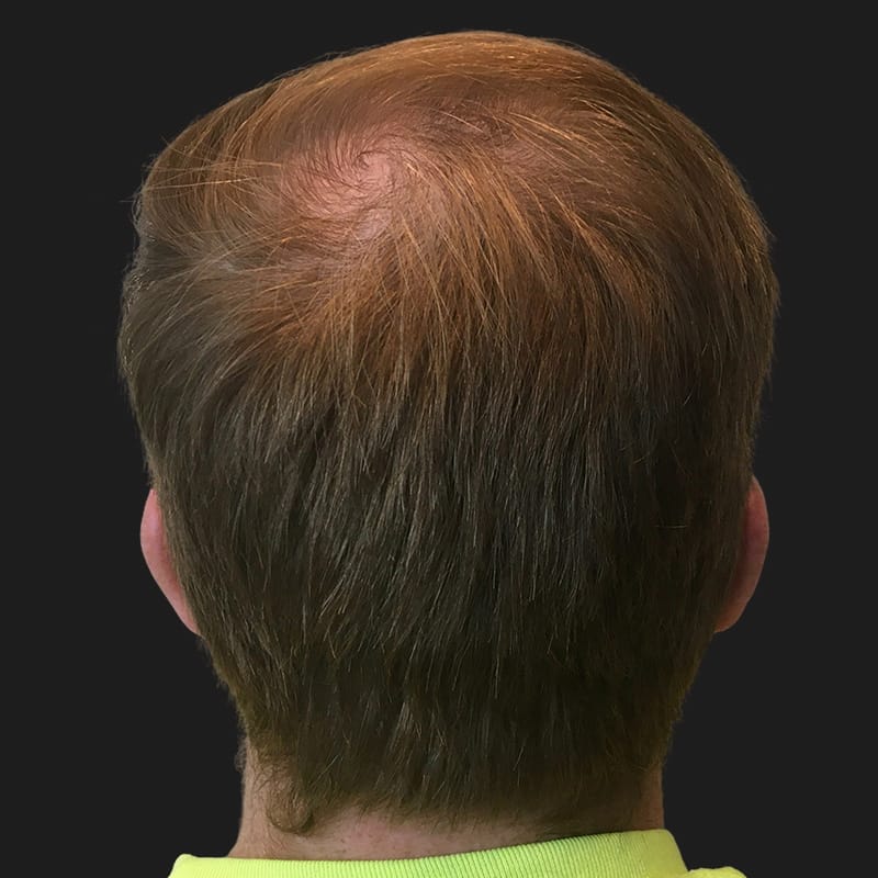 Hair Transplant Case 09