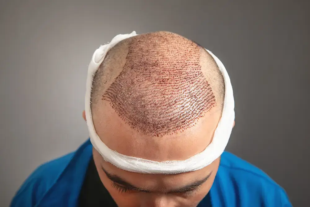 Top 10 Benefits Of Choosing FUE Hair Transplant Over Traditional Methods