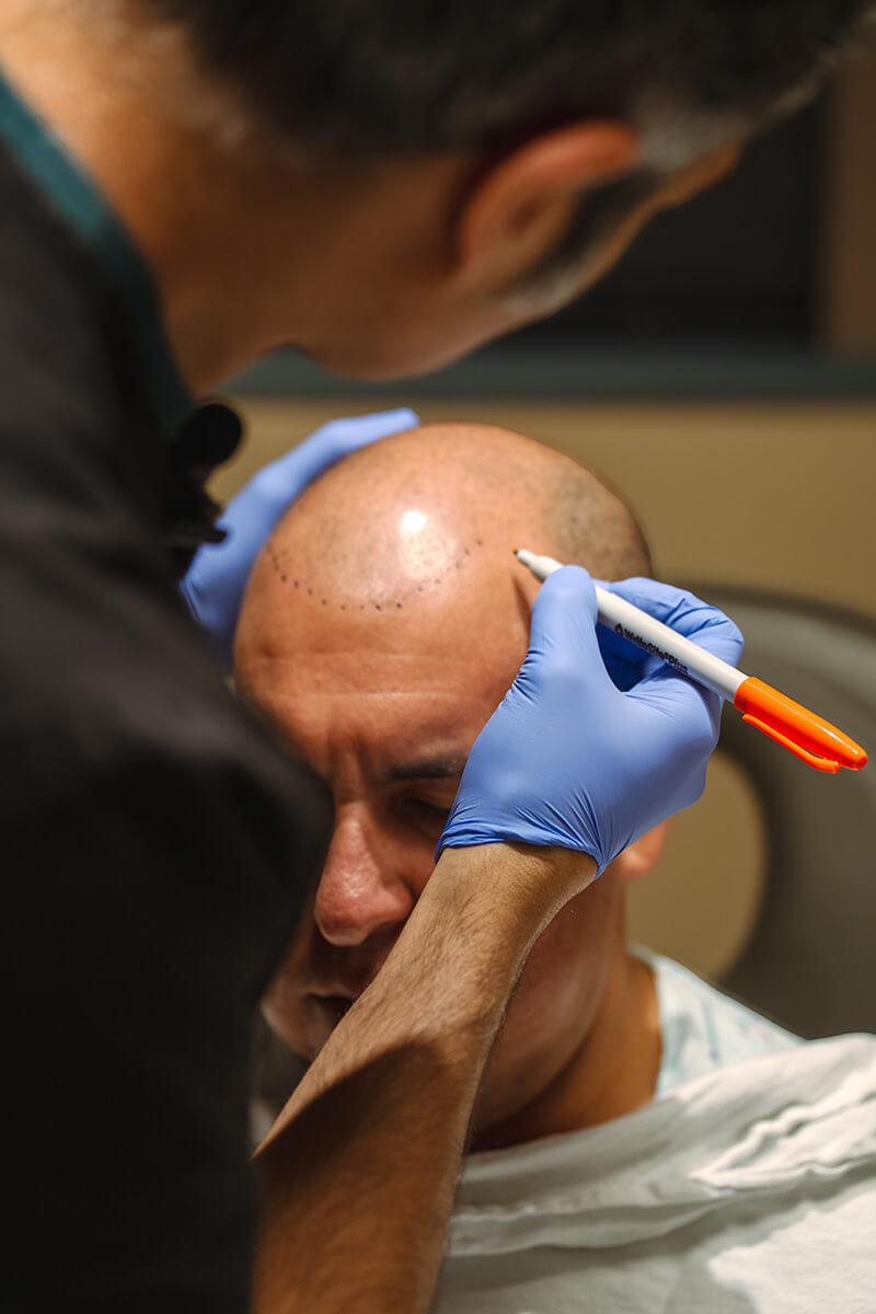 Hair Transplant Cost in Seattle: A Complete Guide to FUT vs. FUE Procedures