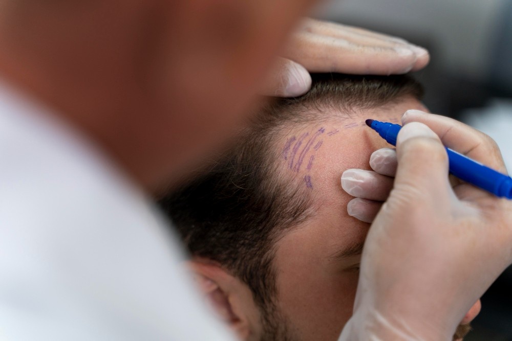 Do Hair Transplants Last Forever?