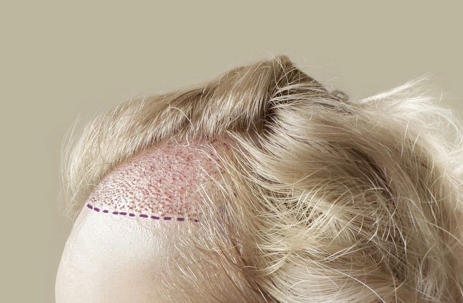 Can Steroids Cause Hair Loss? A Complete Guide