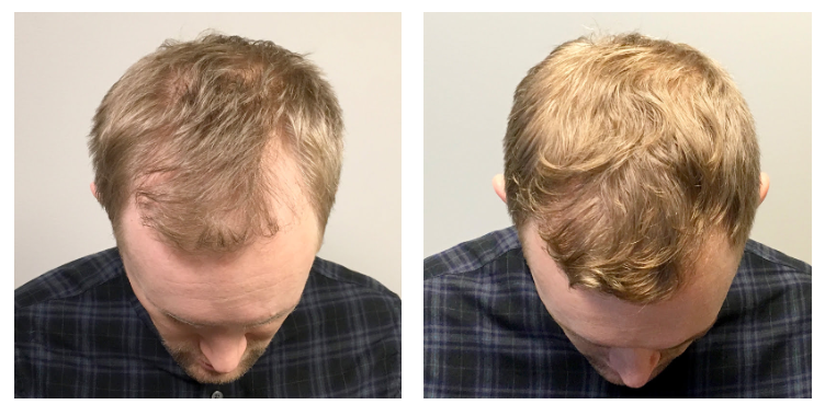 Hair Restoration Before and After