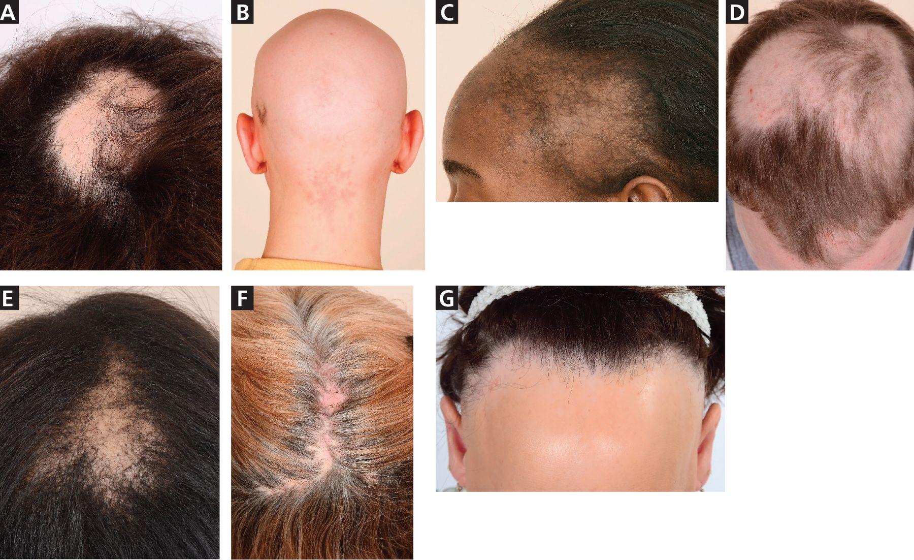 androgenetic alopecia